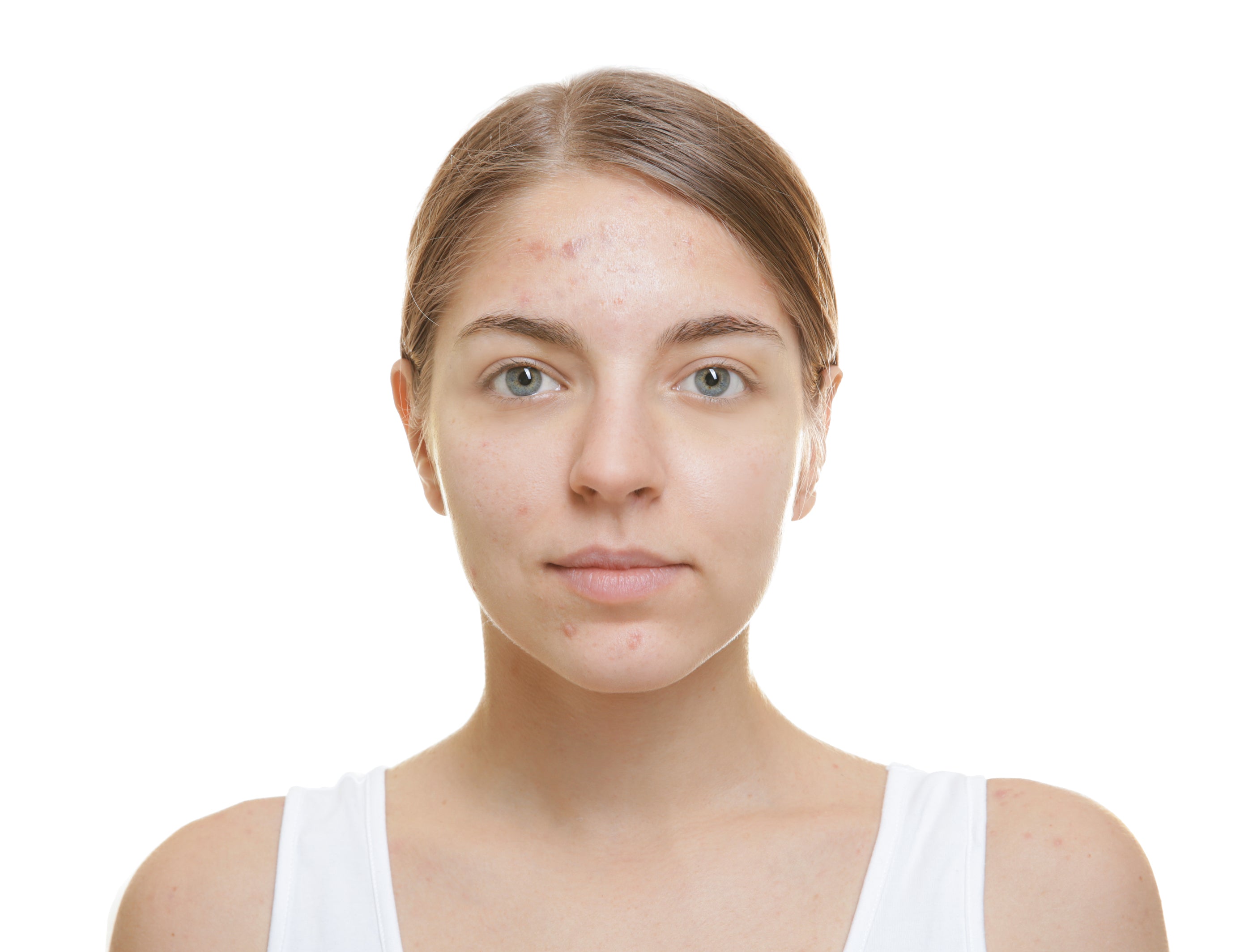 A woman with light brown hair pulled back wearing a simple white tank top in an article about treating teens breakout-prone skin