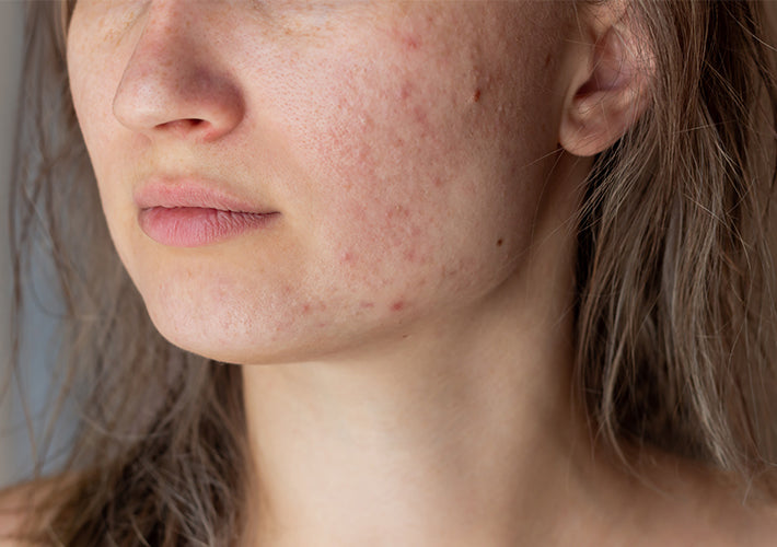 A close-up of a woman with light brown hair and fair skin showing acne in an article about cleansing and acne myths.