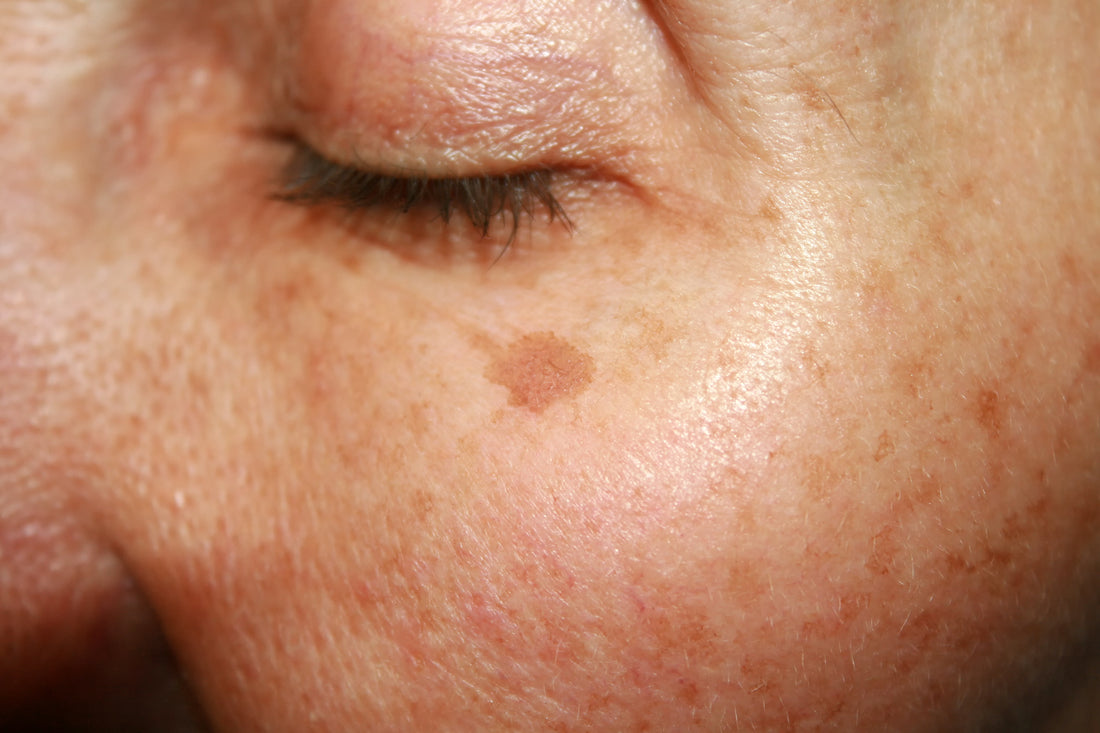 A close-up of a brown slightly raised mole on fair skin near the inner corner of an eye showing sudden dark patches.