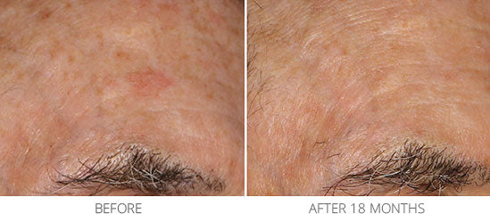 Before and after comparison in radiance plus showing improved skin texture and tone after 18 months