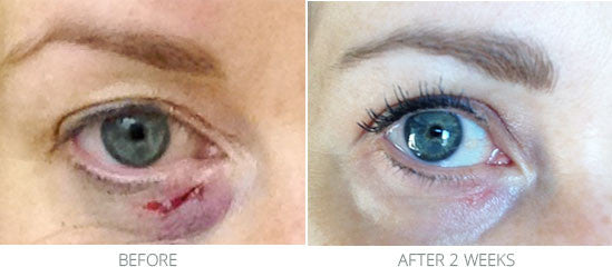 The eye shows a noticeable change in color from hazel to bright blue after two weeks in injury treatment before and afters