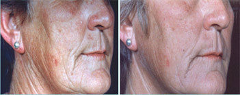 Close-up of an older woman’s face with wrinkles and pearl earrings showing skin texture in combination treatment before and after