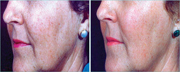 Side-by-side comparison of a woman’s face before and after using focus care radiance plus skin treatment