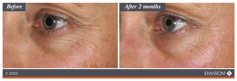 The image shows a before-and-after comparison of an eye area, with the ’after 2 months’ side displaying visibly smoother skin and reduced fine lines compared to the initial state.