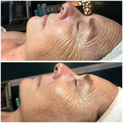 The top image shows a woman’s face with visible wrinkles and skin texture, while the bottom image displays the same area after treatment, appearing smoother and more radiant.