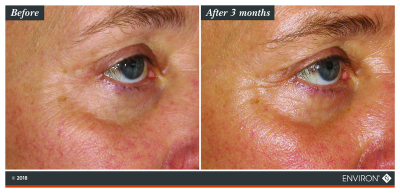 The image shows a before-and-after comparison of an eye area, with the ’after 3 months’ side displaying visibly smoother skin and reduced redness compared to the initial state.