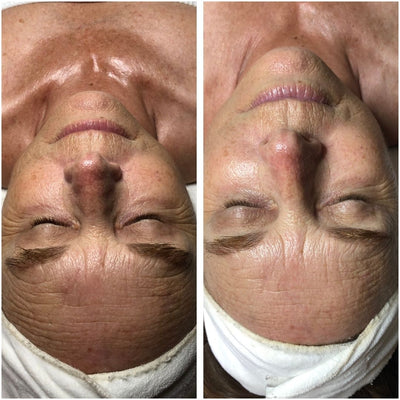 The before-and-after facial treatment results showcase a woman’s skin transformation, with the left side displaying visible signs of aging and the right side revealing smoother, more youthful-looking skin.