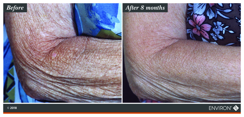 The image shows a before-and-after comparison of an elderly person’s arm, highlighting the skin’s texture and appearance.