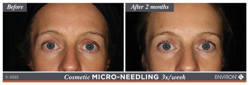 The image displays a before-and-after comparison of cosmetic micro-needling treatment, showing the results after two months.