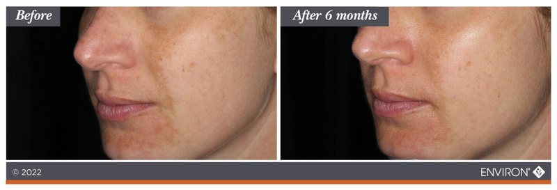 The image displays a before-and-after comparison of skin tone, with the right side showing noticeably lighter and more even complexion after six months.