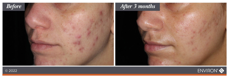 Environ skincare product results showing a noticeable reduction in acne and skin imperfections after three months of use.