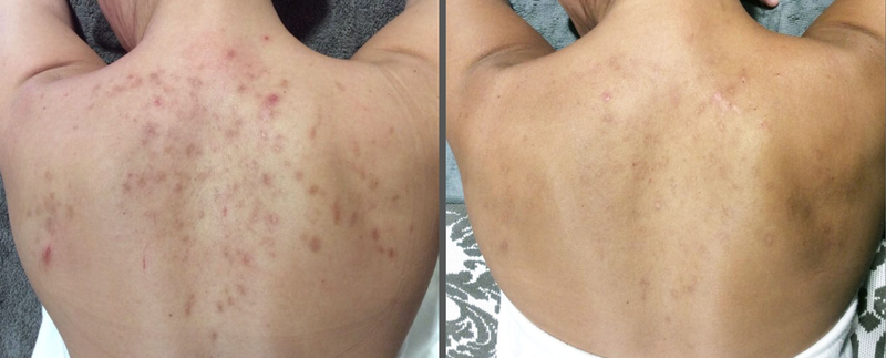 The image shows a person’s back with visible skin blemishes and acne scars, presented in two side-by-side comparisons.