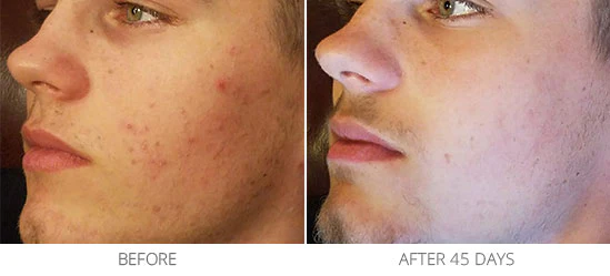 The image shows a before-and-after comparison of a man’s face, highlighting skin improvement over 45 days.