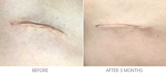 A healed surgical scar, now flat and fading to match the skin tone.