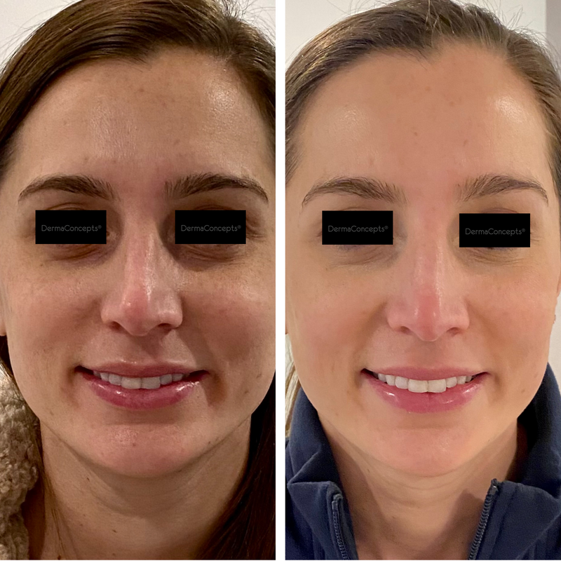 A woman’s face before and after a dermaconcepts® skincare treatment, showing improved skin clarity and tone.