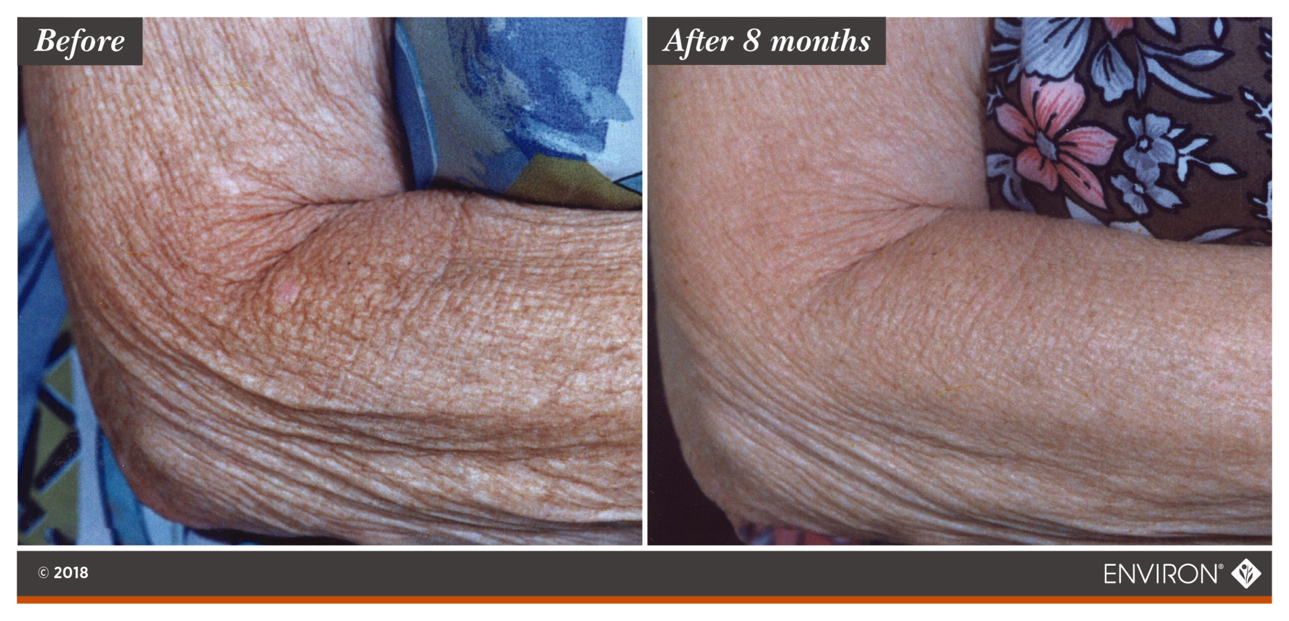 The image shows a before-and-after comparison of an elderly person’s arm, highlighting the skin’s texture and appearance over eight months.