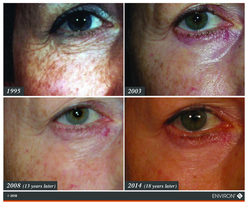 The image displays a collage of four close-up photographs showing the same eye area at different years: 1995, 2003, 2008 (13 years later), and 2014 (1