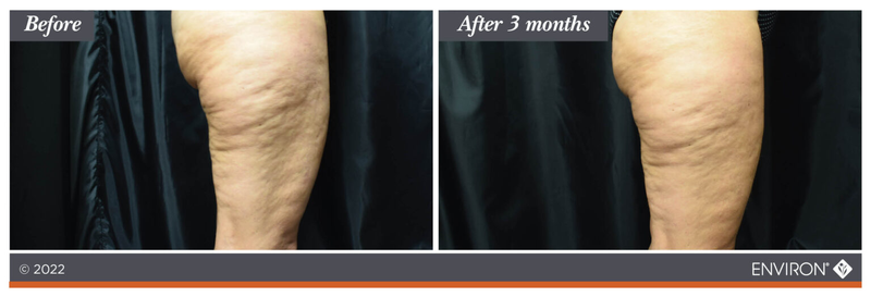 The image shows a before-and-after comparison of skin on the lower leg, with no product or object to describe.