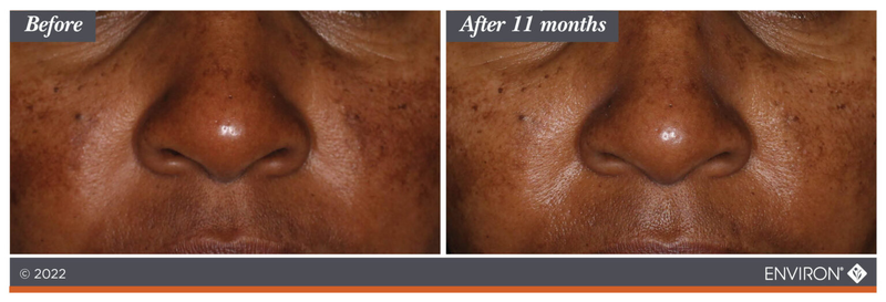 Environ skincare product results shown on a person’s nose before and after 11 months of use.
