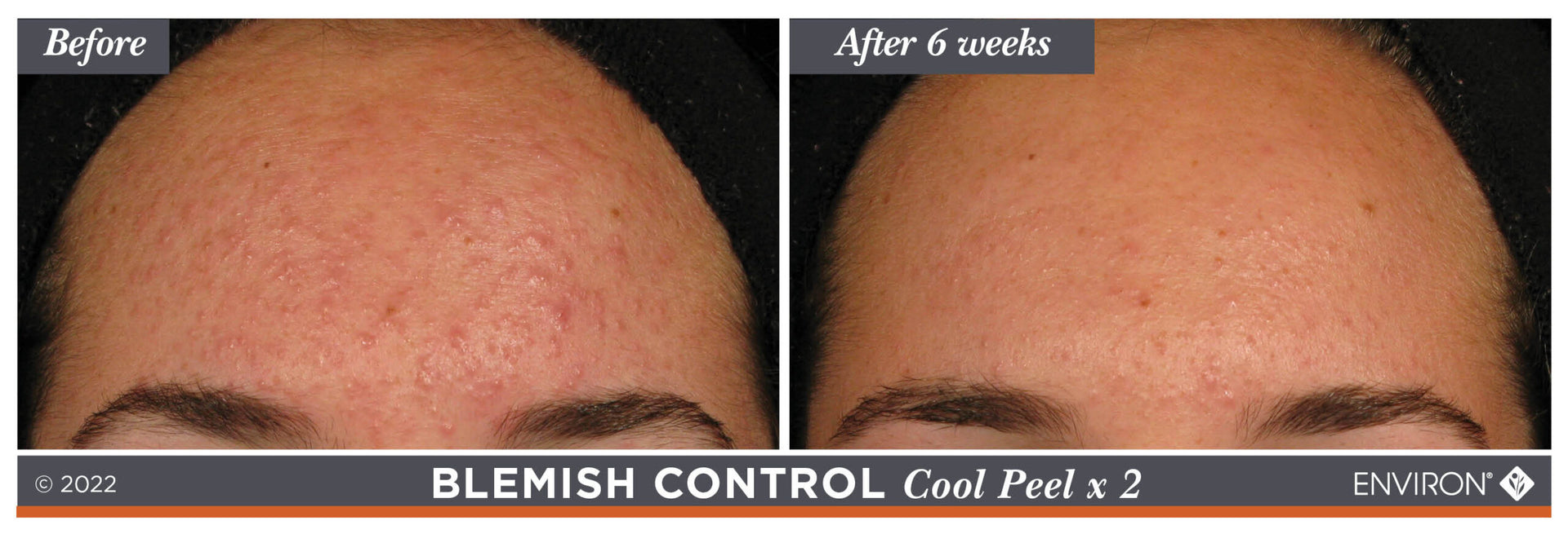 Environ blemish control cool peel x2, a skincare treatment product designed for acne-prone skin.