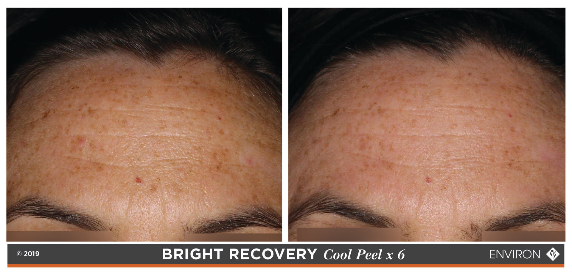 The image displays a before-and-after comparison of skin treated with the environ bright recovery cool peel, showing improved clarity and reduced discoloration.