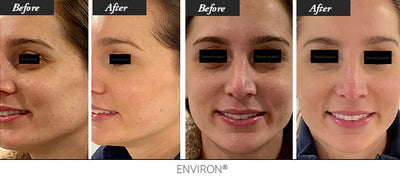 The image displays a before-and-after comparison of facial skin treatment, showcasing smoother and more even-toned results with the environ brand.