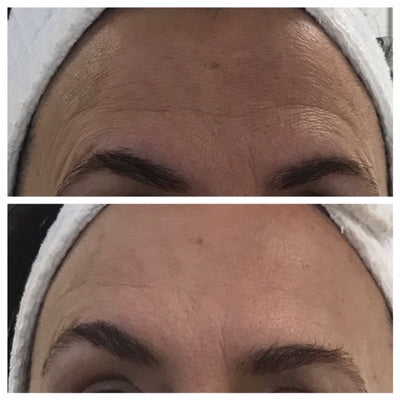 The top image shows a woman’s forehead with visible wrinkles and fine lines, while the bottom image displays smoother skin after treatment.
