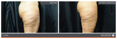 The image shows a before-and-after comparison of a person’s leg, with the ’after’ side appearing smoother and less wrinkled than the ’before’ side.