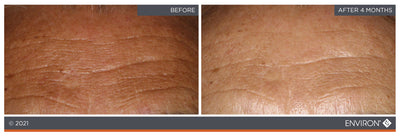 Environ skincare product results showing improved skin texture and reduced fine lines after four months of use.