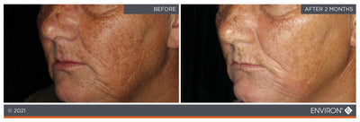 Environ skincare treatment results shown on a person’s face before and after two months.