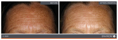 The image shows a before-and-after comparison of skin texture and tone, with the ’after 2 months’ side displaying visibly smoother and more even-toned skin than the ’before’ side.