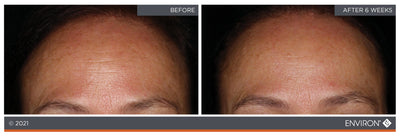The image displays a before-and-after comparison of skin texture, with the ’after’ side showing visibly smoother and more even-toned skin than the ’before’ side.