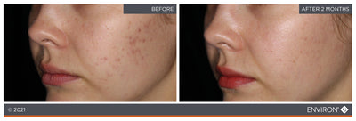 The image displays a before-and-after comparison of skin treatment results, showing noticeable improvement in complexion after two months.