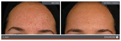 The image shows a before-and-after comparison of skin, with the ’after’ side displaying noticeably clearer and smoother skin than the ’before’ side.
