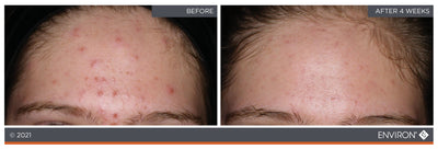 The image shows a before-and-after comparison of skin, with the ’after’ side displaying noticeably clearer and smoother skin than the acne-prone ’before’ side.