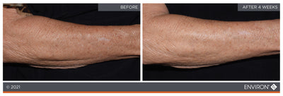The image shows a before-and-after comparison of an arm, with the ’after’ side appearing smoother and less wrinkled than the ’before’ side.