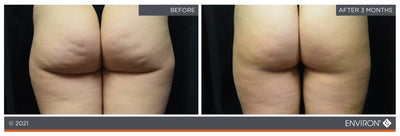 The image shows a before-and-after comparison of buttocks, with the ’after’ side appearing smoother and more toned than the ’before’ side.