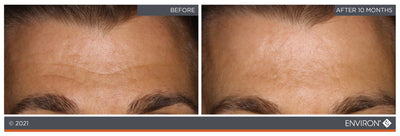 The image shows a before-and-after comparison of skin texture, with the ’after’ side displaying smoother and more even-toned skin.