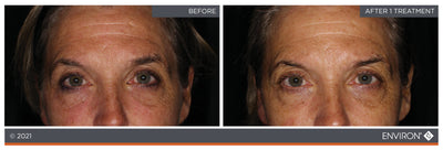 The image shows a before-and-after comparison of facial skin treatment, with the ’after’ side displaying visibly smoother and more even-toned skin.