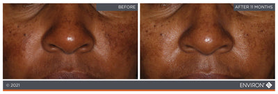 Environ skincare treatment results showing a smoother, more even-toned complexion after 11 months.