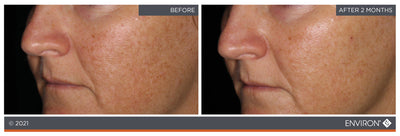 Environ skincare treatment results showcasing improved skin texture and tone after two months.