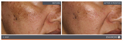 Environ skincare treatment results showing improved skin tone and texture after four months.