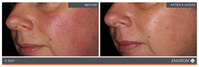 Environ skincare treatment results showing improved skin texture and tone after six weeks.