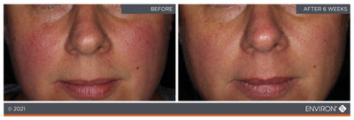Environ skincare before-and-after facial treatment results showing improved skin texture and tone.