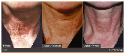 The image displays a before-and-after comparison of skin on the neck, showing visible improvements in texture and tone over time.
