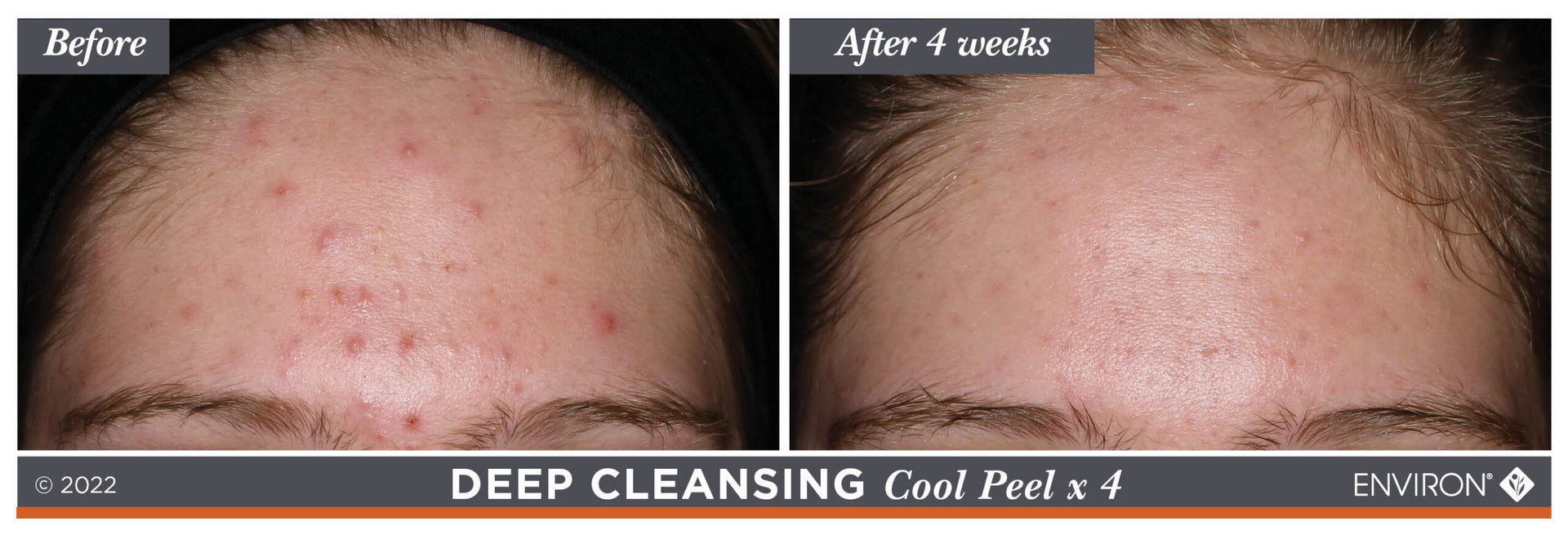 The image displays a before-and-after comparison of skin treatment results, showcasing the effectiveness of environ’s deep cleansing cool peel x 4.