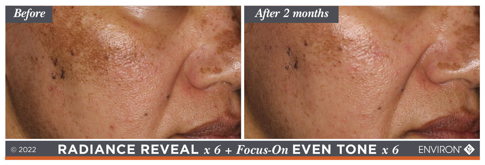 The image displays a before-and-after comparison of skin tone improvement, showcasing the results from an environ radiance reveal x6 + focus-on even tone x6 treatment.