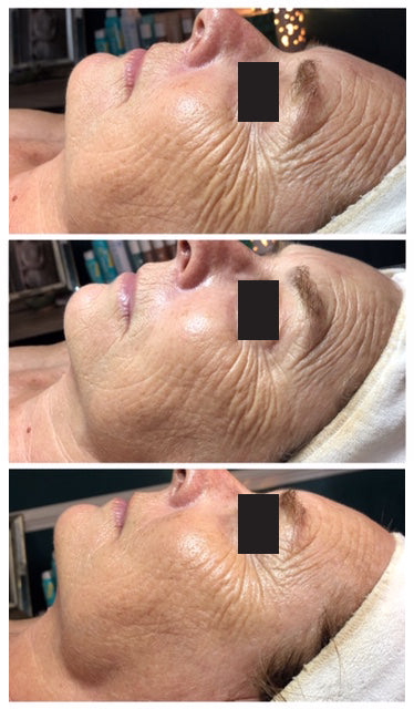 A woman’s face with visible wrinkles and fine lines, showing a before-and-after comparison of skincare treatment.