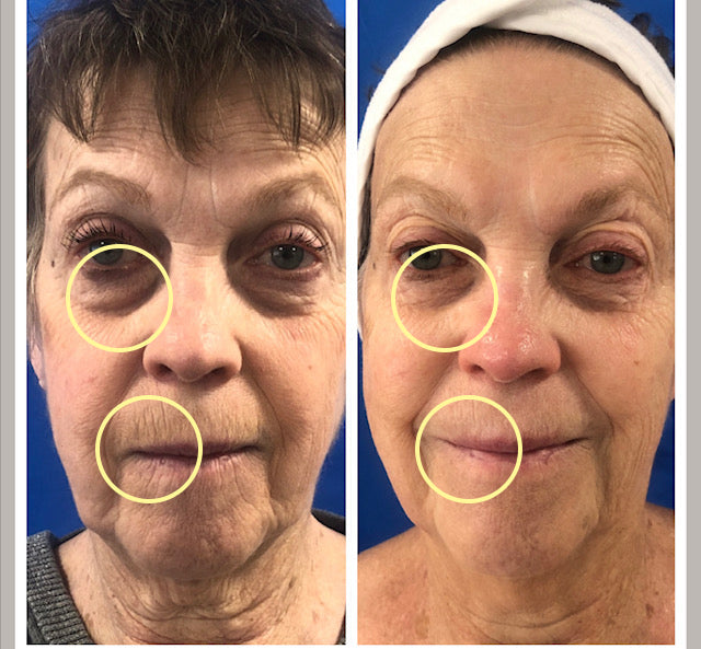 The before-and-after facial comparison image highlights the woman’s eyes and mouth with yellow circles, showcasing visible skin texture and wrinkles on her face.