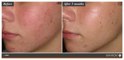 The image shows a before-and-after comparison of skin, with the ’after 3 months’ side displaying noticeably clearer and smoother skin than the initial condition.